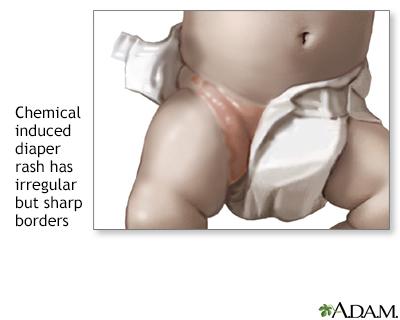 Sensitive Skin? The Best Diapers for Babies With Allergies
