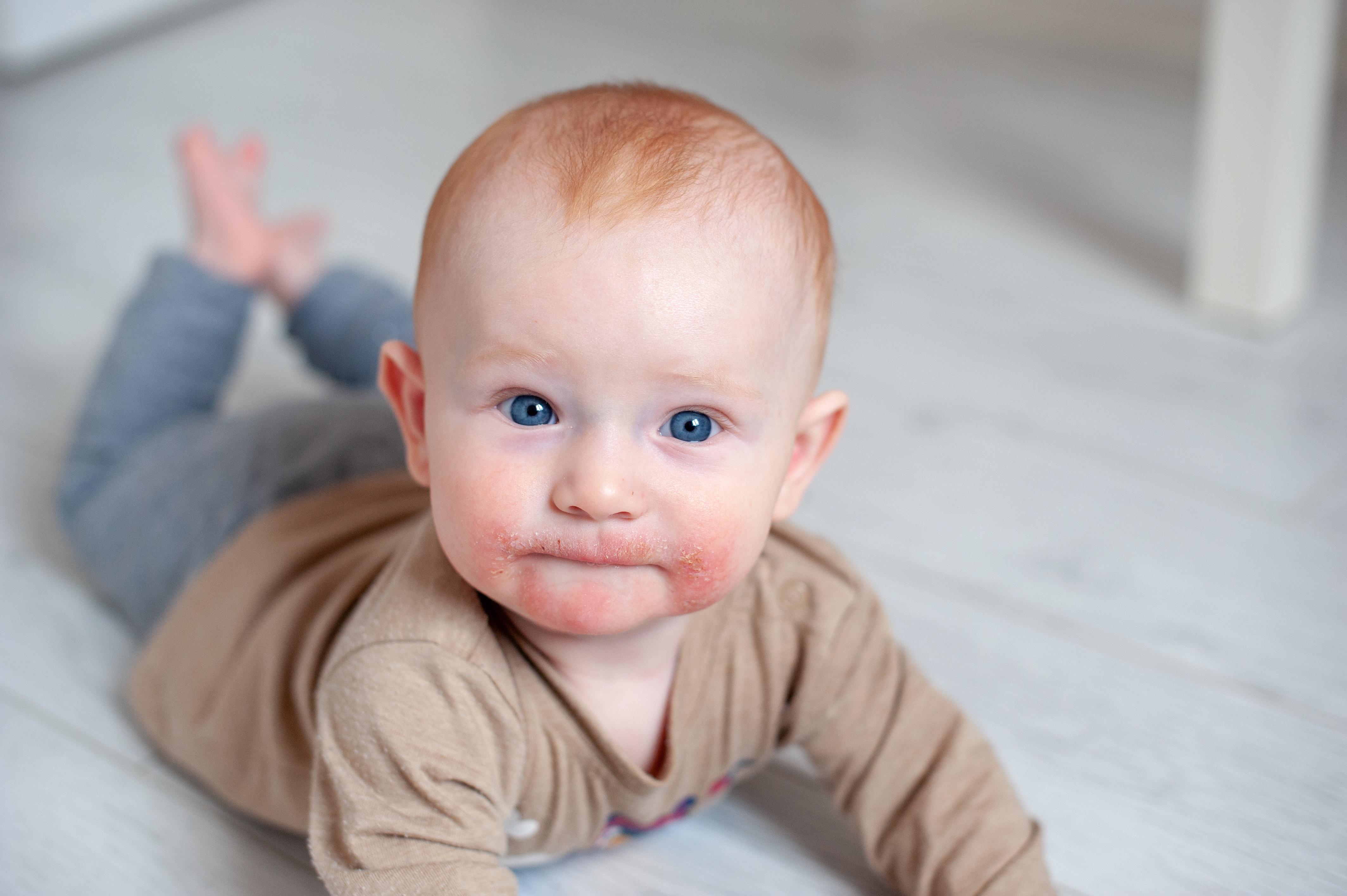 Understanding Sensitive Skin and Common Allergens in Baby Diapers