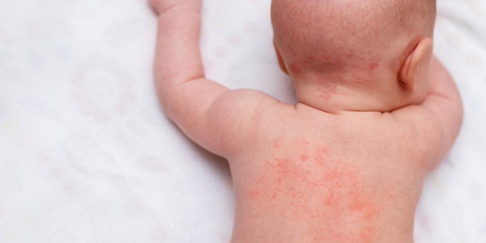 Key Ingredients to Avoid for Allergy-Prone Babies